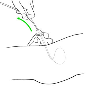 16.Hand removing urinary catheter-boy