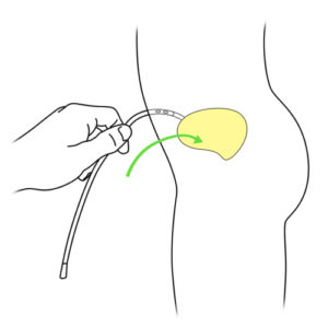 19.Hand inserting the catheter into stoma of Mitrofanoff