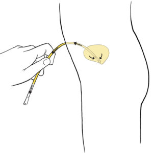 20.Hand using the urinary catheter to empty the bladder by the stoma of Mitrofanoff