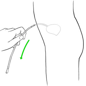 21.Hand withdrawing catheter through the stoma of Mitrofanoff