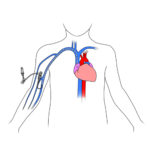 Parenteral nutrition - Complex care at home for children