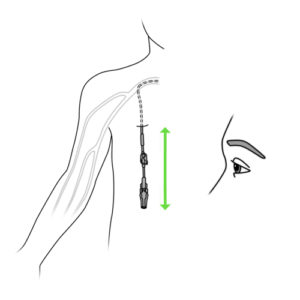 318.1Measuring the length of the external part of the catheter