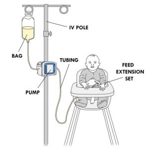 Your Child's Nasogastric Tube: Pump Feeding