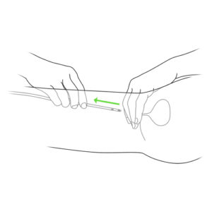 8.Hand removing urinary catheter-girl
