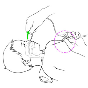 Nasopharyngeal suction removal