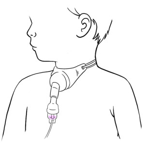 528.Nebulizer connected to tracheal collar